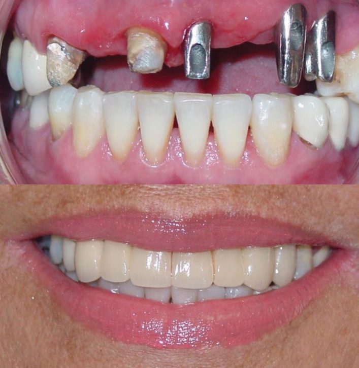Dental implants